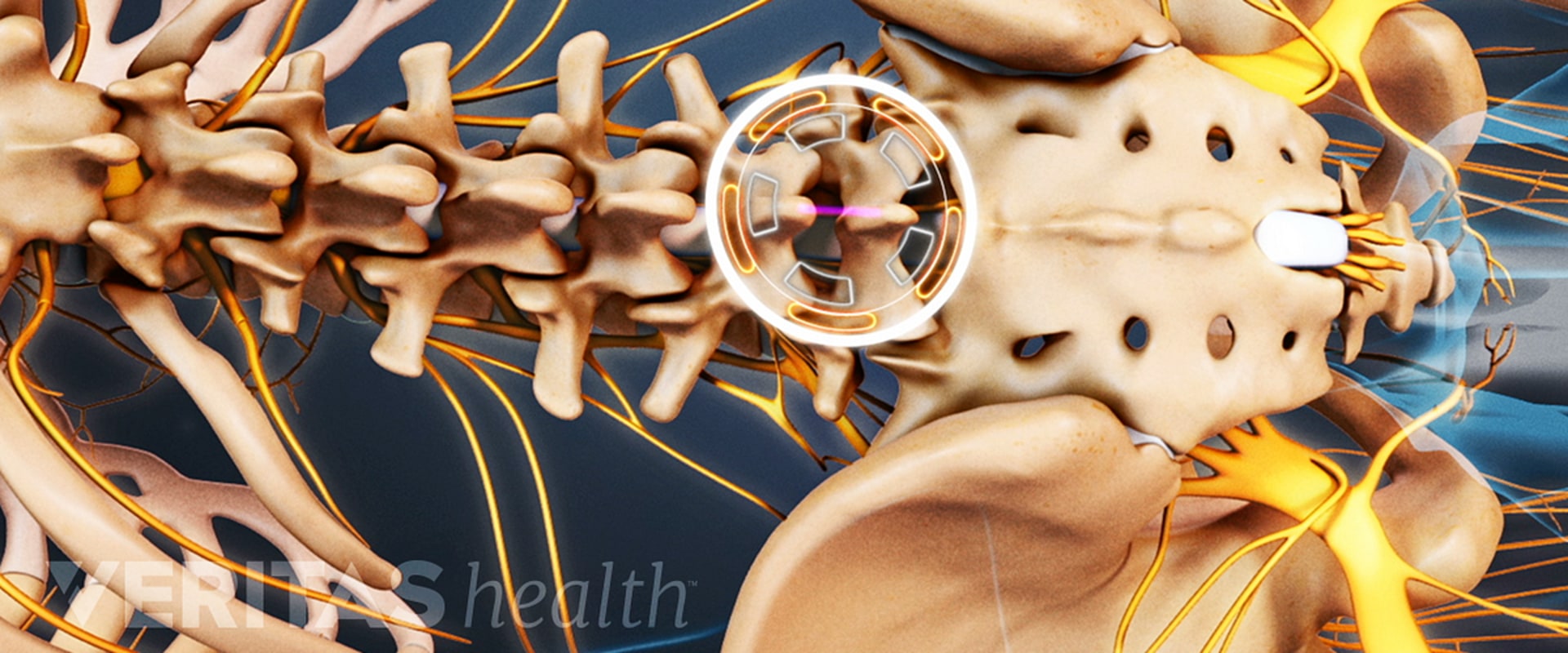 Who needs spinal decompression surgery?