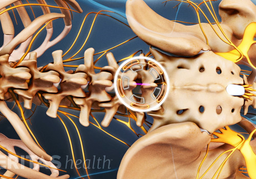 Is spinal decompression a major surgery?